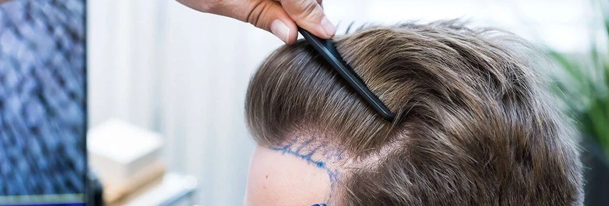 FUE-пересадка волос в Турции