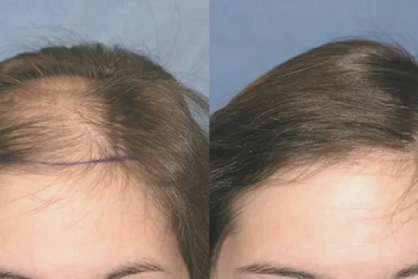 Haartransplantation für Frauen in der Türkei