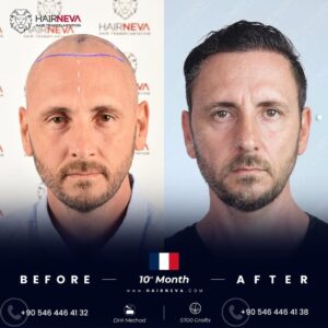 Saç Ekimi Sonrası En Doğal Görünen Saç Modelleri