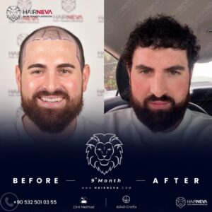 Saç Ekimi Sonrası En Doğal Görünen Saç Modelleri