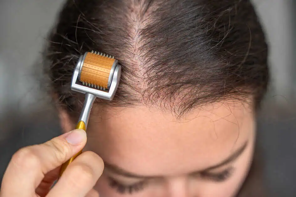 Microneedling for Hair Loss: A Comprehensive Look at Its Effectiveness and Benefits