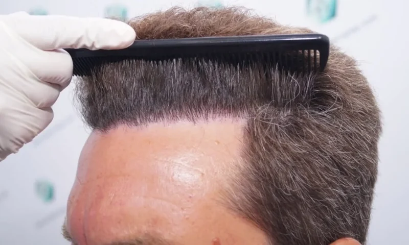 Haartransplantation ohne Rasur in der Türkei