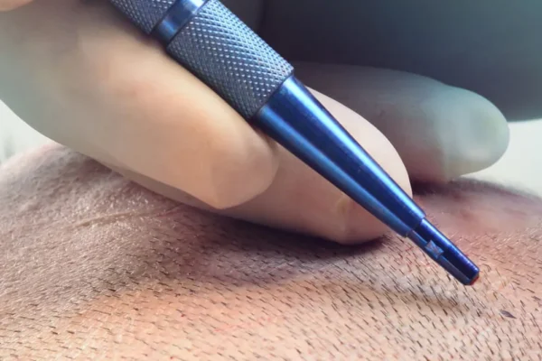 Сапфировая пересадка волос в Турции