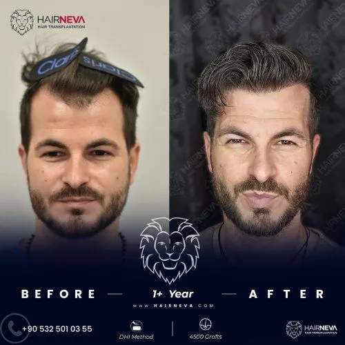 Tıraşsız Saç Ekimi