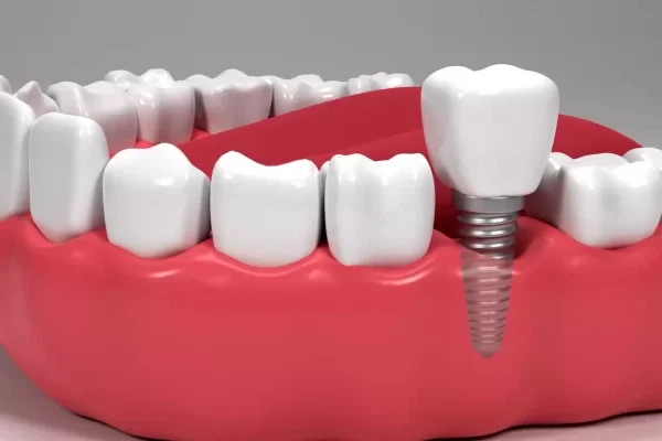 Dental Implants Turkey