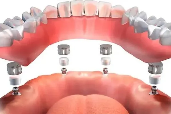 Full Teeth Implants in Turkey