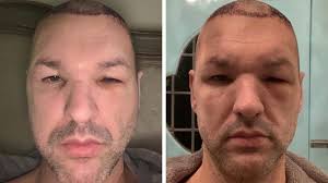Head Trauma After Hair Transplant