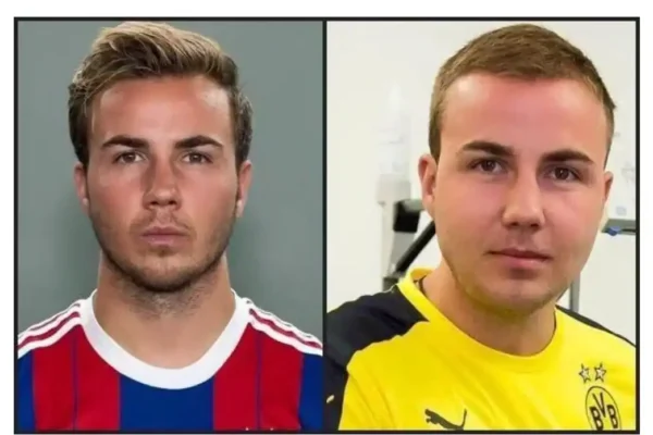 Mario Götze Hair Transplant