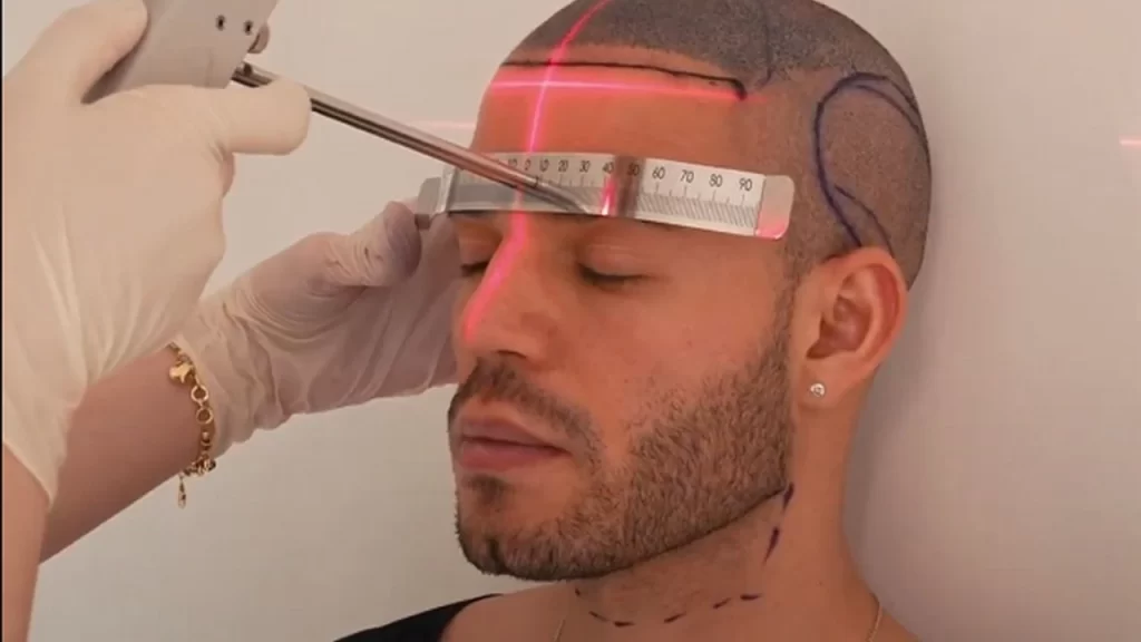 Saç Ekimi Yaptıran Ünlüler