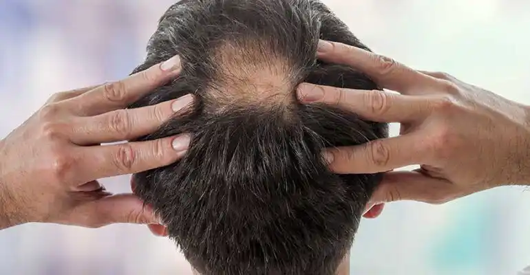 Tepe Bölgesi Açıklığında Saç Modeli Nasıl Olmalı?