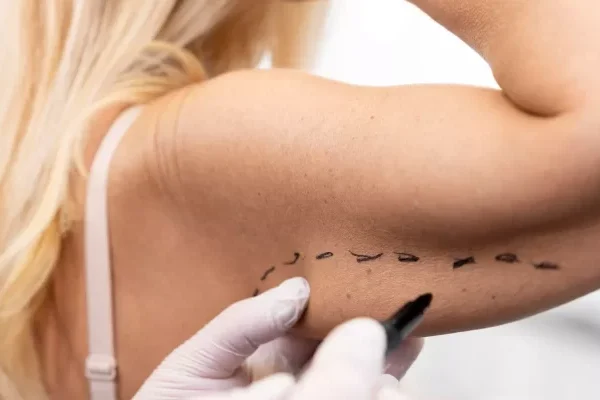 Upper Arm Aesthetics