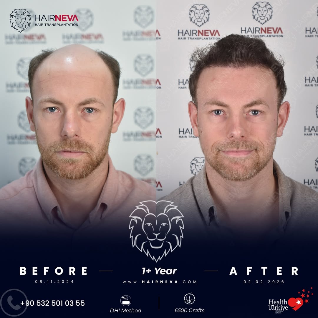 Hair Transplant Turkey 7 1