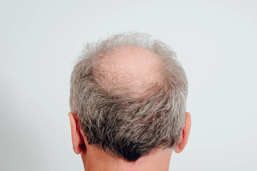 أولئك الذين يريدون زرع الشعر الانتباه!