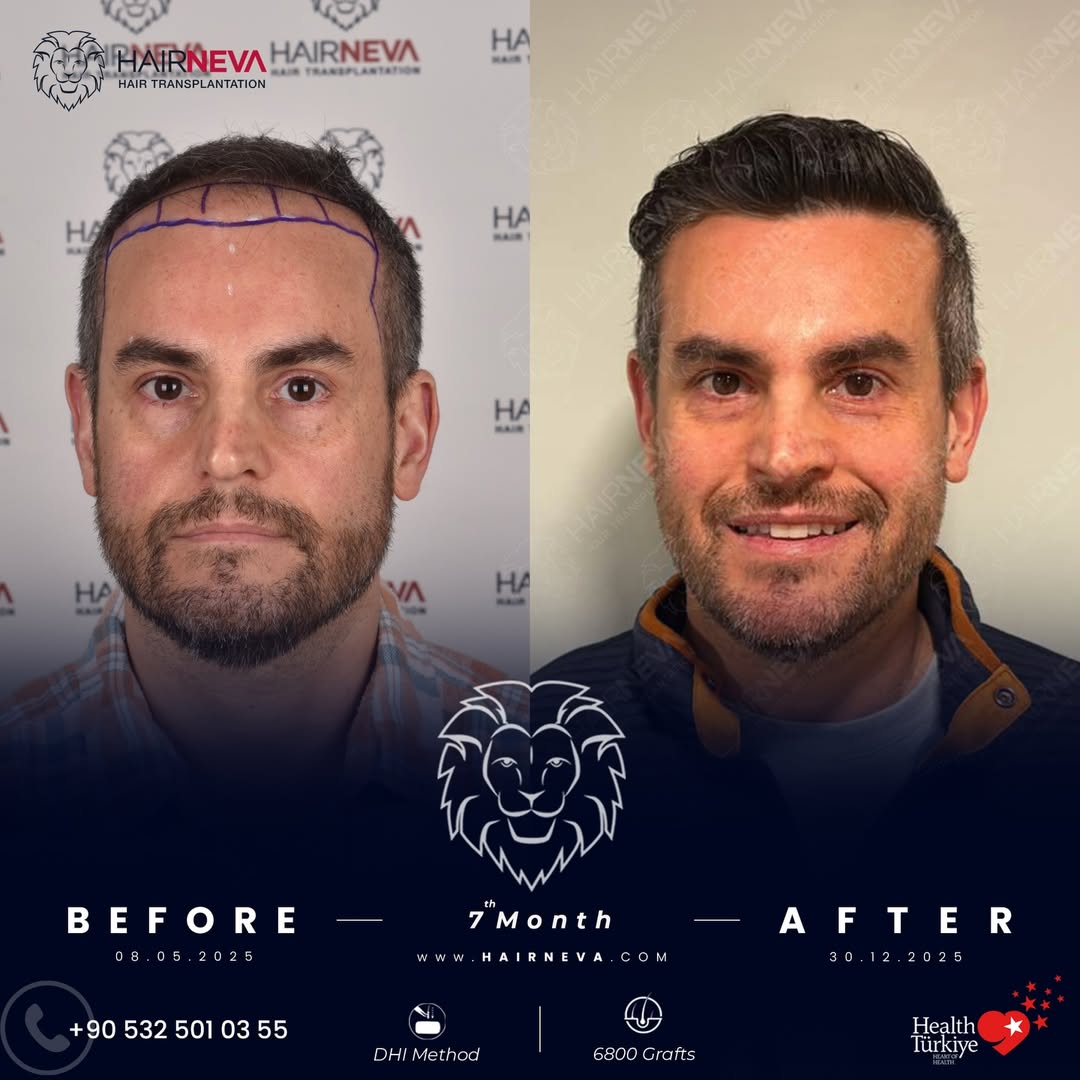 Пересадка волос в Турции 27 2.jpg