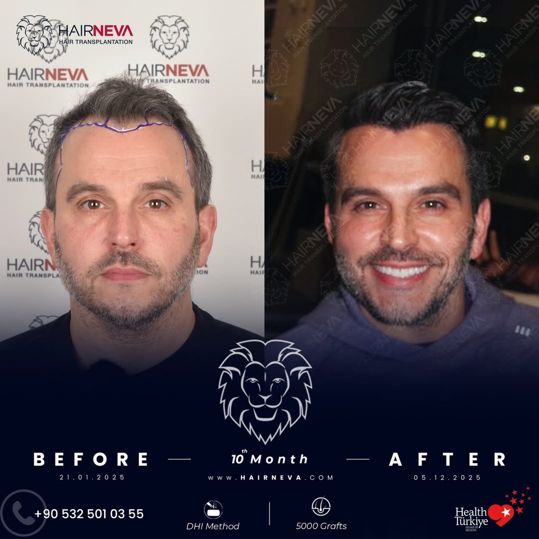 Hair Transplant Turkey 8 3