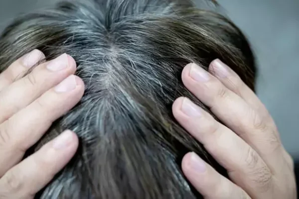 هل سيتساقط شعري بعد زراعة الشع