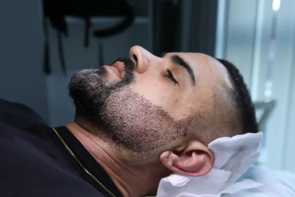 زراعة 5000 بصيلات الشعر