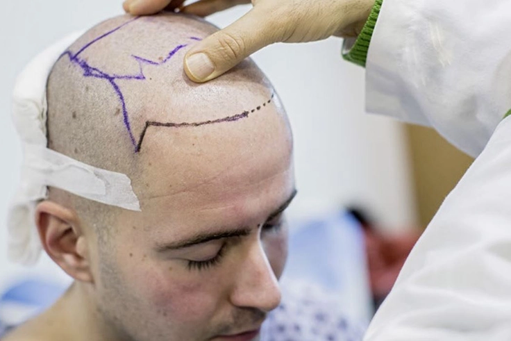 Hair Transplant Combined with Alternative Treatments: A Comprehensive Guide