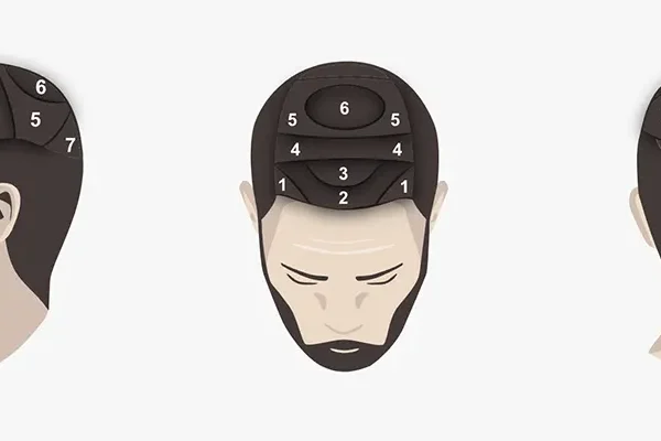 How the hair transplant price is calculated, what affects prices?