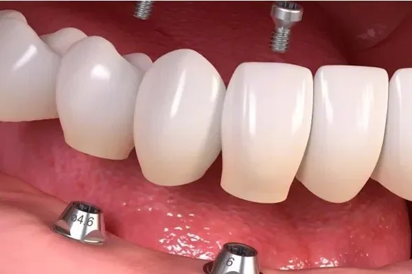 Implant Supported Prosthesis