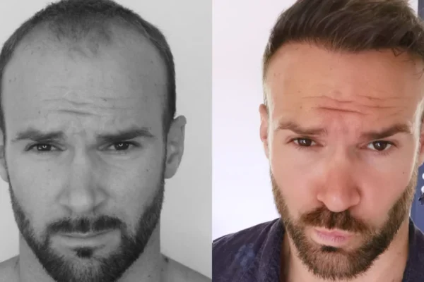 Hair Transplant Recovery Timeline: How Long Does It Take to Fully Heal?