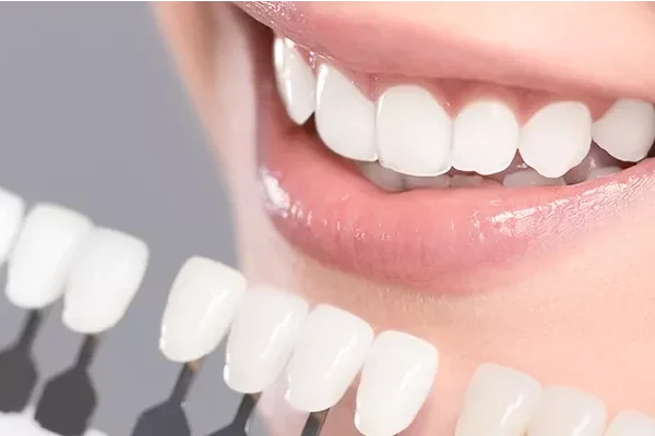 Laminate Veneer Turkey