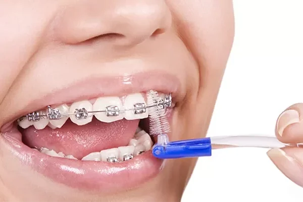 Orthodontic Treatment