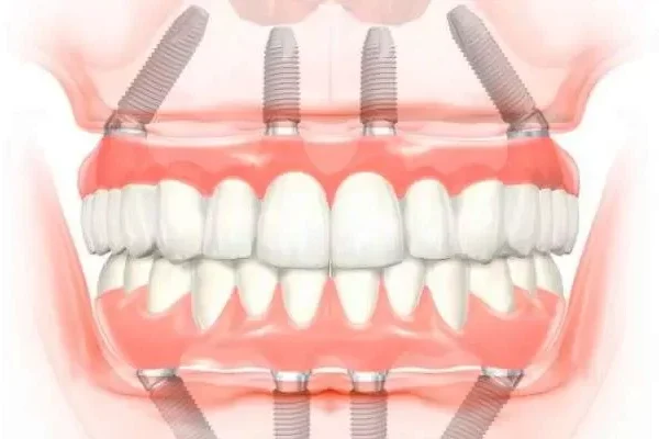 Removable Prosthesis