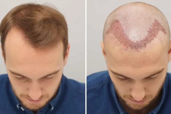 Raccomandazioni prima e dopo l’impianto dei capelli