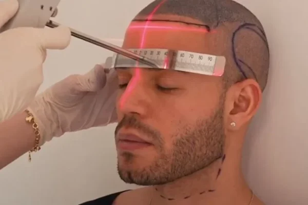 Saç Ekimi Yaptıran Ünlüler