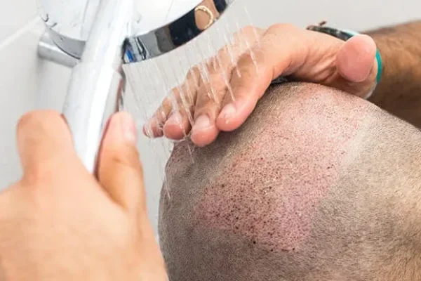 Swimming and Using Sauna/Turkish Bath after Hair Transplant Surgery