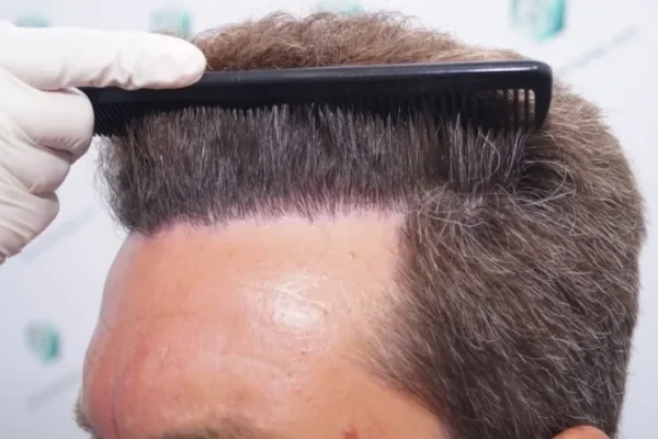 Trapianto di capelli non rasati in Turchia