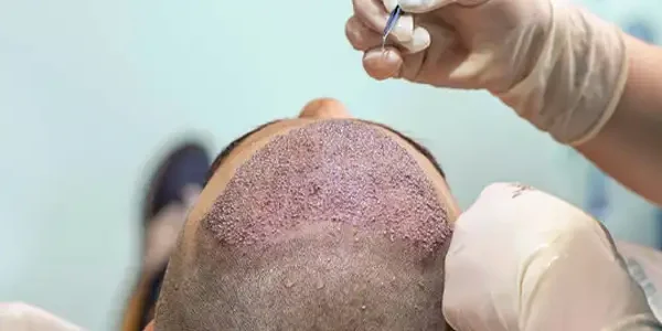 ما هي مزايا وعيوب تقنية FUE في زراعة الشعر؟