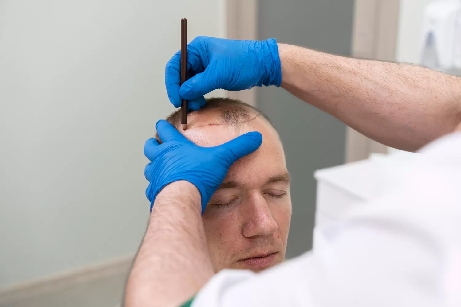 Impact of Graft Number on Hair Transplant Results