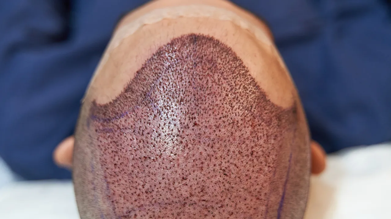 Hair Pigmentation: Enhance Your Look Without Surgery