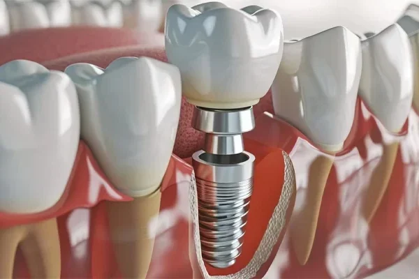 Zygomatic Implant Turkey