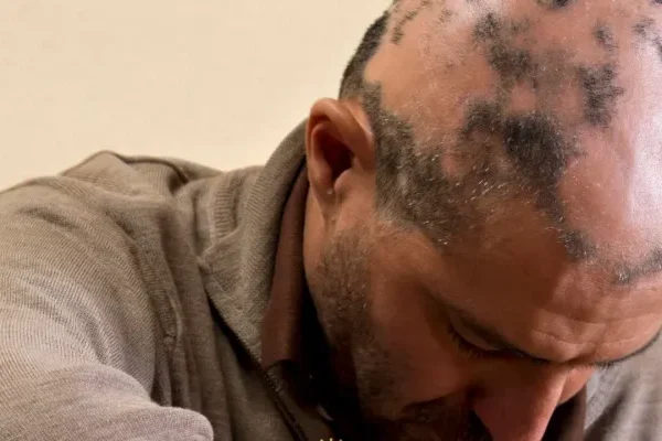 متى يبدأ الشعر في النمو بعد زرع الشعر؟