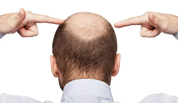 Was sind die Auswirkungen einer fehlerhaften Haartransplantation?