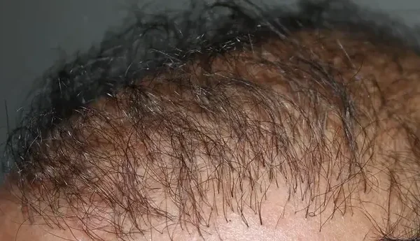 Correcting Previous Hair Transplant Mistakes