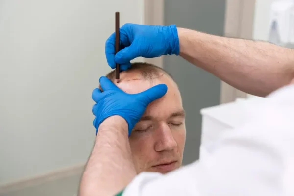 Choosing the Right Hair Transplant Surgeon: Credentials to Look For