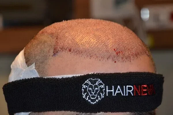 1.500 Graft Haartransplantation
