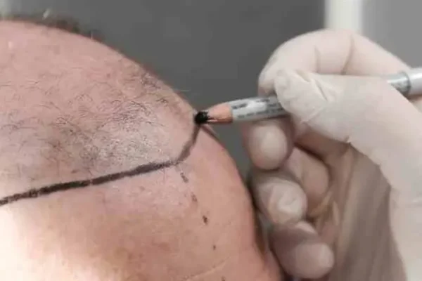 ما هي أضرار زرع الشعر الخاطئ للشخص