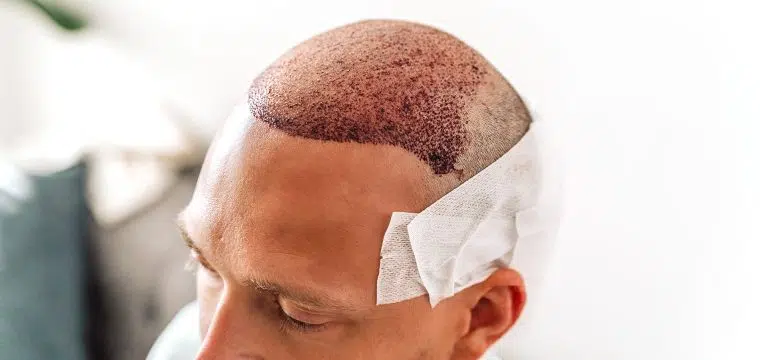 Understanding Hair Follicle Anatomy for Better Transplant Results