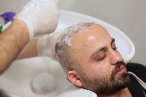 Scalp Care Routine Post-Hair Transplant