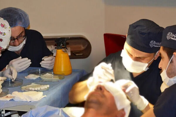 3.000 Graft Haartransplantation