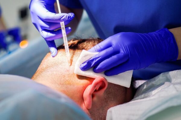 Implanter Tekniği ile Saç Ekimi