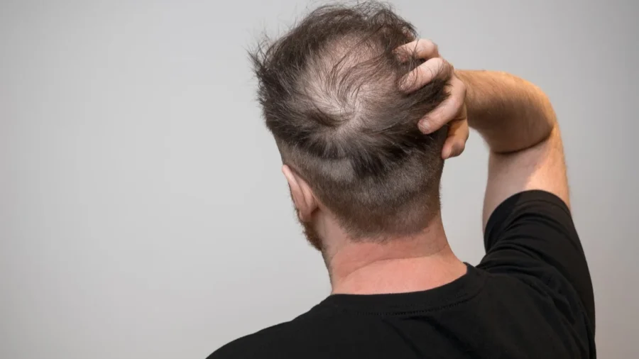 زراعة الشعر للشعر الخفيف