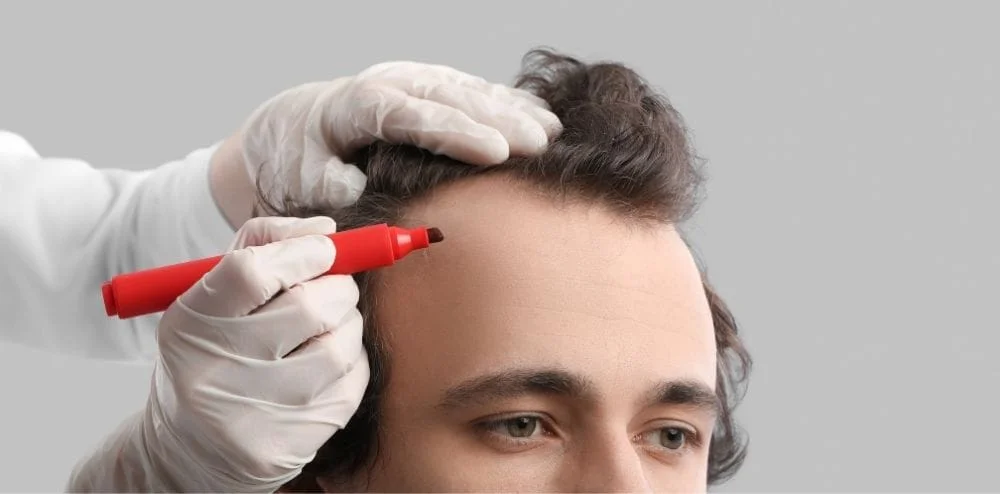 Getting Ready for Your Hair Transplant Journey: Pre-Operation Considerations