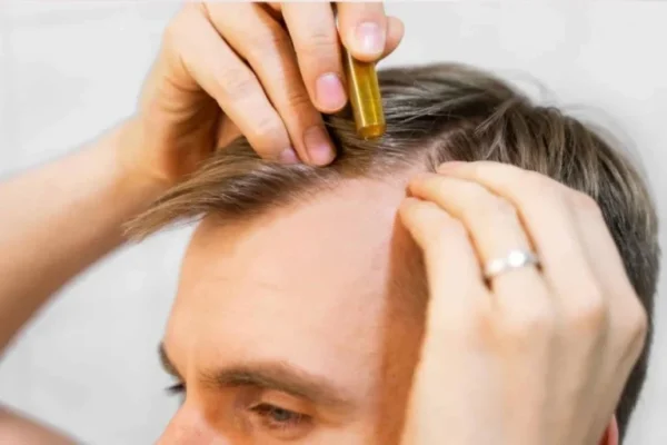 Lazerle Saç Çizgisi Belirleme