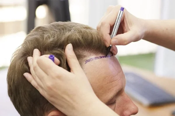 FUE mi DHI mı? Saç Ekiminde Hangisi Tercih Edilmeli?